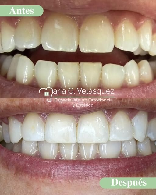 Antes y después de un diseño de sonrisa