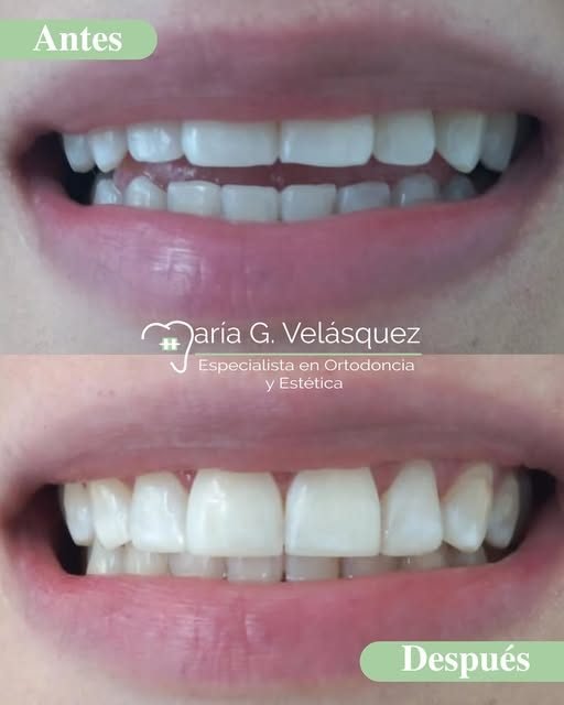 Antes y después de un tratamiento estético