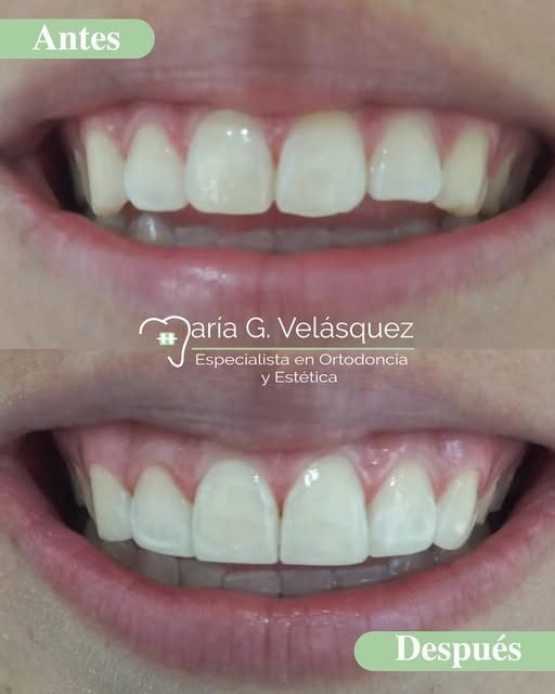 Antes y después de un diseño de sonrisa